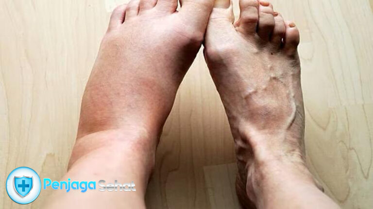 7 Obat Kaki Bengkak yang Ampu